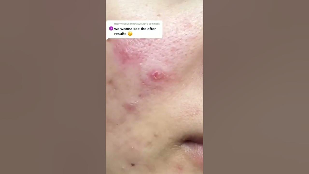 Big pimples loan nguyen Blackheads remove at home YouTube