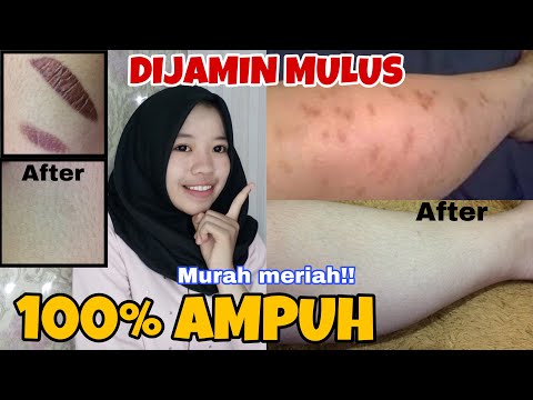 CARA CEPAT MENGHILANGKAN BEKAS LUKA (KORENGAN) PADA KAKI, TANGAN, WAJAH!! 100% ampuh!!