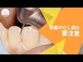 自分では気付かない!?前歯の虫歯は要注意 Difficult To Know About Caries Of The Front Teeth?!