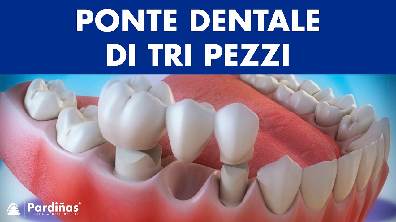 Ponte dentale di tri pezzi ©