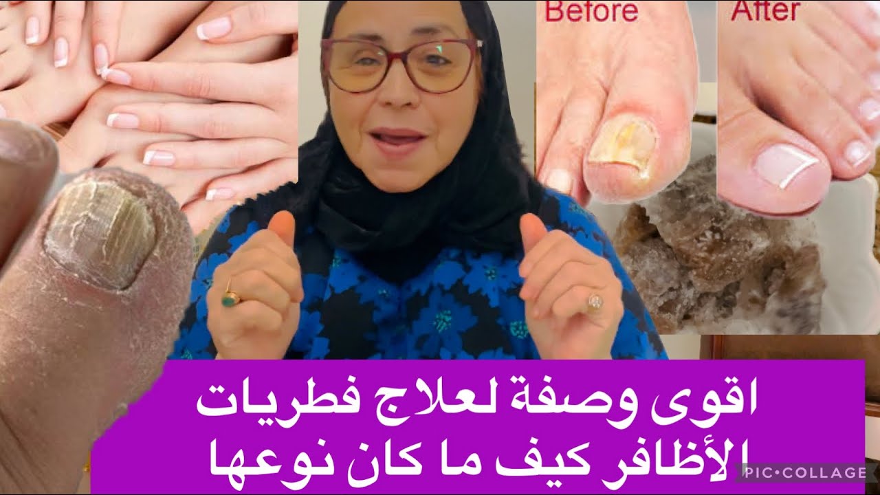 الحل النهائي السريع لعلاج فطريات الأظافر  أقوى وصفة تهنيك من الفطريات الى الابد