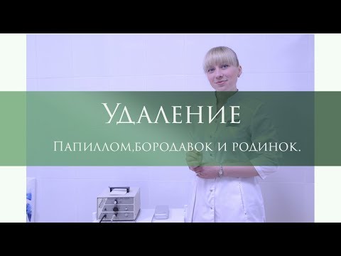 Удаление бородавок