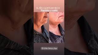 Fibroblastos #fibroblast #plasmapen #elrioclinicayspa