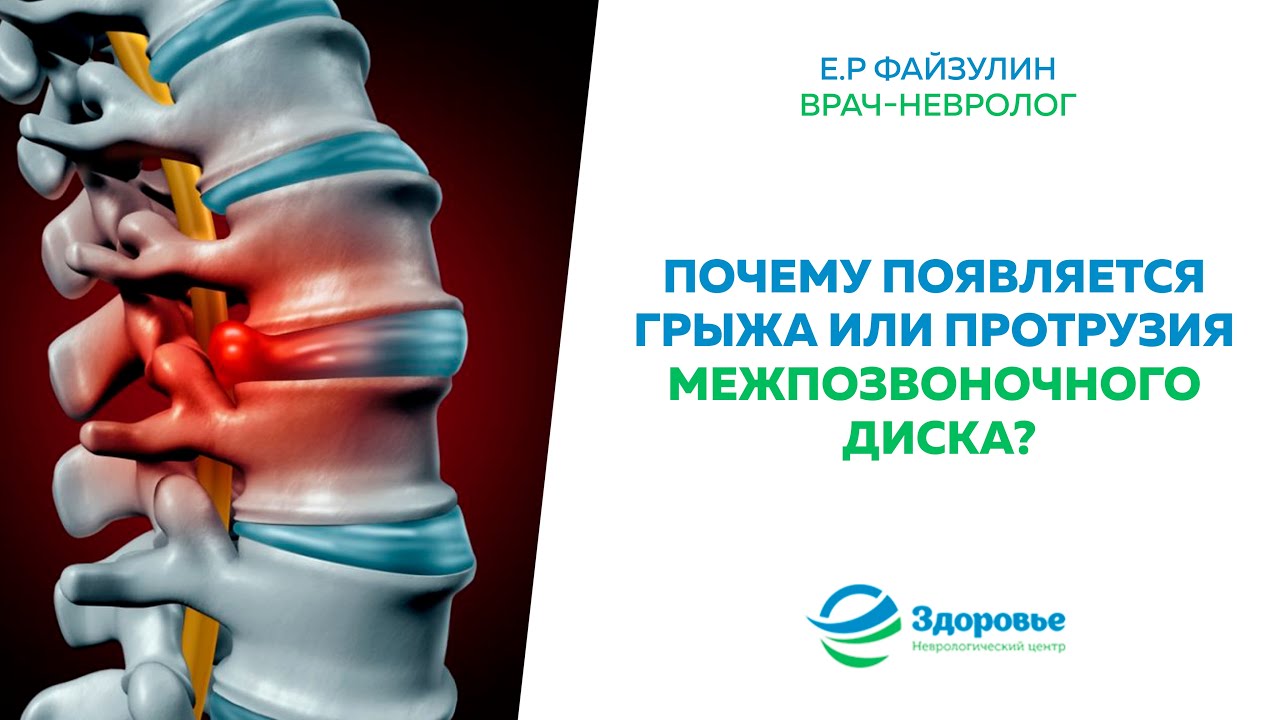 Формирование грыжи позвоночного диска - YouTube