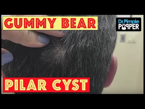 A Cyst That Reminds Us Of... Gummy Bears!!