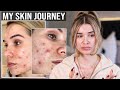 My Skin Story... Going on ACCUTANE