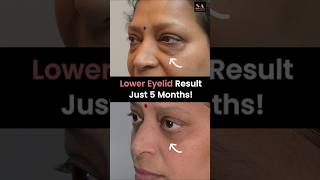 Lower Eyelid Transformation Just 5 Months! | Lower Eyelid Surgery in Delhi | Blepharoplasty Surgery