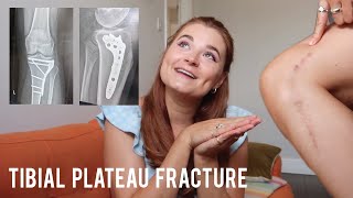 6 MONTH UPDATE - Tibial Plateau Fracture ORIF Surgery Recovery