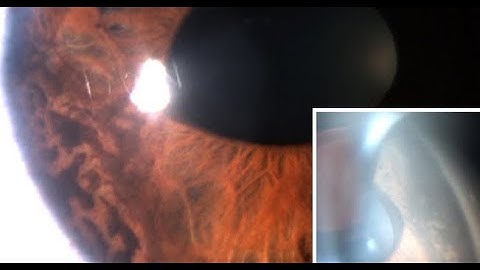 1 Slide in 5 Minutes: Iridocorneal Endothelial (ICE) Syndrome (Malik Y. Kahook, MD)