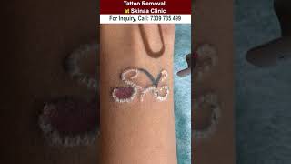 Tattoo removal at skinaa clinic #shorts screenshot 2