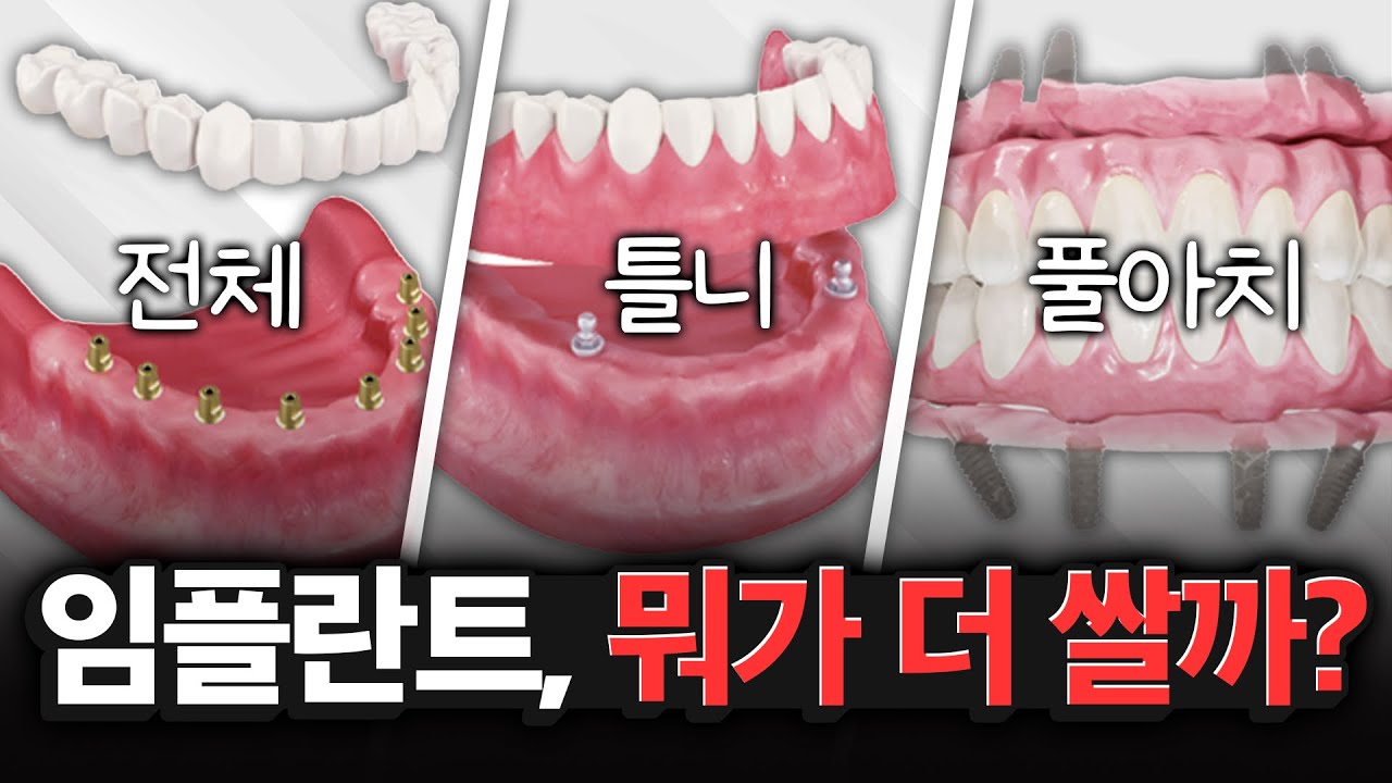 전체 임플란트 vs 임플란트 틀니 vs 풀아치 임플란트, 이 가격 밑으로는 하지 마세요