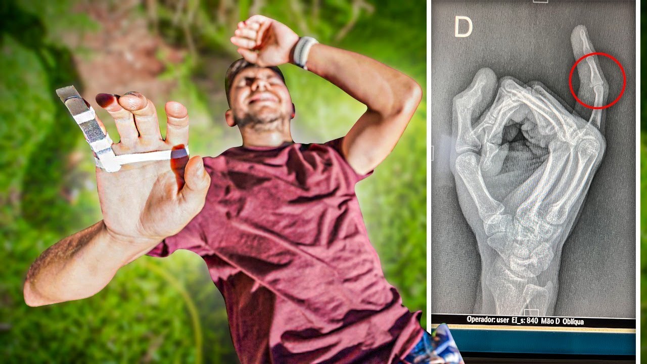 QUEBREI MEU DEDO INFELIZMENTE