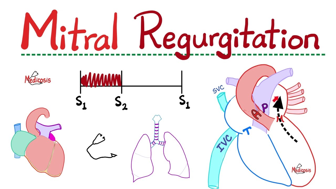 Mitral Regurgitaion (MR) - Valvular Heart Disease (VHD) - Mitral valve Insufficiency - Cardiology🫀