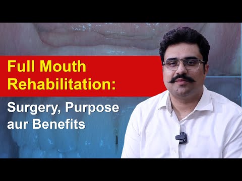 Full mouth rehabilitation and All-on-4 dental implants explained