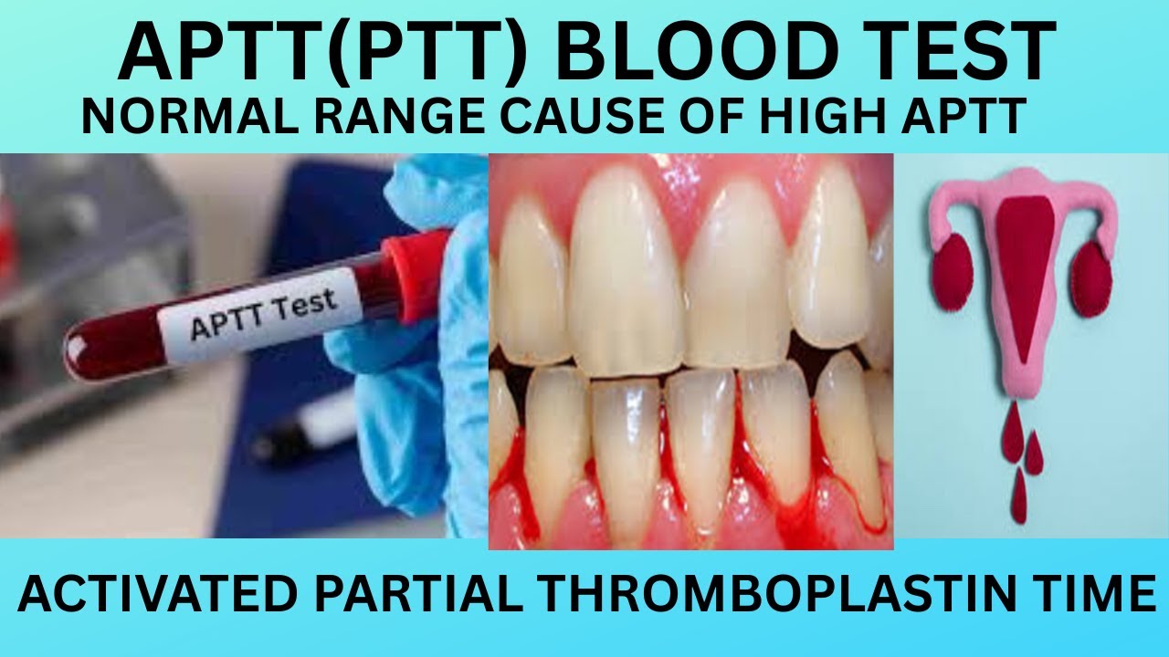 APTT BLOOD TEST.PTT( partial thromboplastin time) NORMAL RANGE CAUSES ...