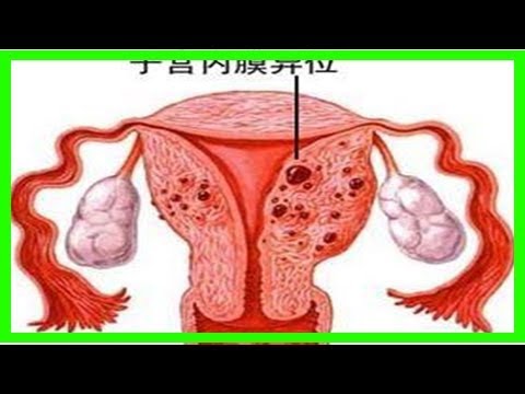 女大學生肚痛，體內竟割出一灘黑水！醫生：痛經這個信號不能小看