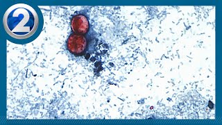 Weather Fourth case of cyclosporiasis confirmed in Hawaiʻi: DOH Sky View