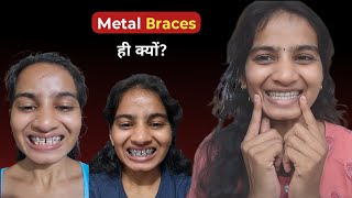 The reason I choose metal Braces 🤫|| Must watch before getting Braces ❗🦷