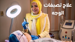 علاج تصبغات الوجه | اسباب تضبغات البشرة و علاجها