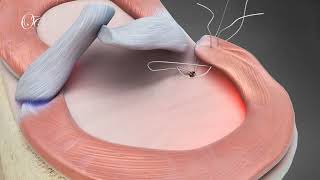 RootFix Anchor : Innovative Patented Technique to Repair Meniscus Root Tears screenshot 5