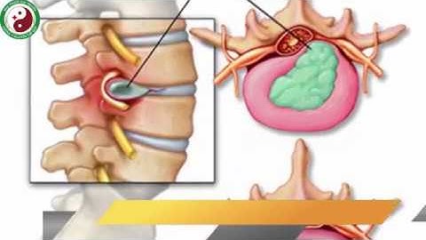 Chữa thoát vị đĩa đệm L5S1 hẹp tủy/ chèn ống sống/ Đông y chữa thoát vị đĩa đệm an toàn nhất