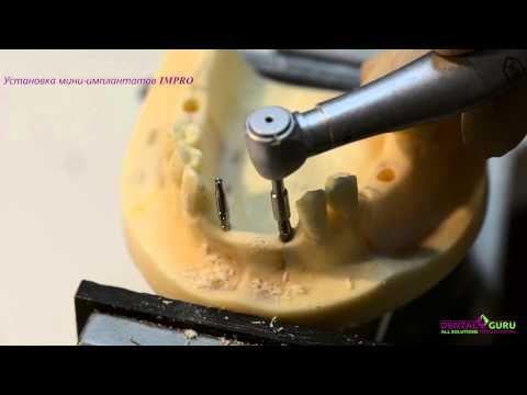 Video: Endosteal Implant: Druhy A Postupy Zubných Implantátov