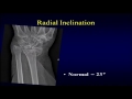 Distal radius fractures: what to look for on radiographs