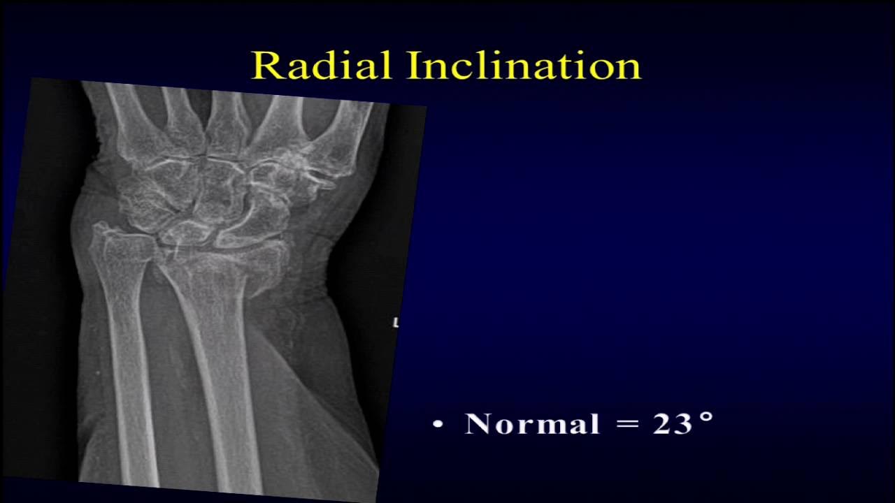 Radius fracture. Outcomes of the fractures of distal humeri. treatment of distal fractures.