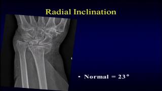 Distal radius fractures: what to look for on radiographs