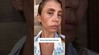 Remove Dark Sports &amp; PigmentationNaturally At Home | Get Clear &amp; Fair Skin.#viral #videoshort