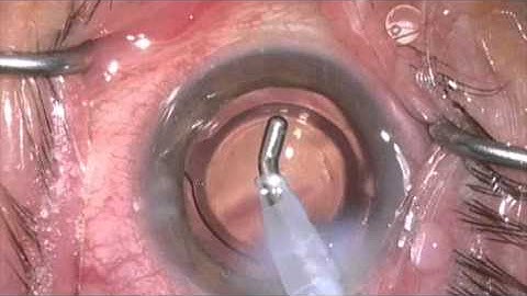 iStent placement and verification of function by Steven G. Safran MD