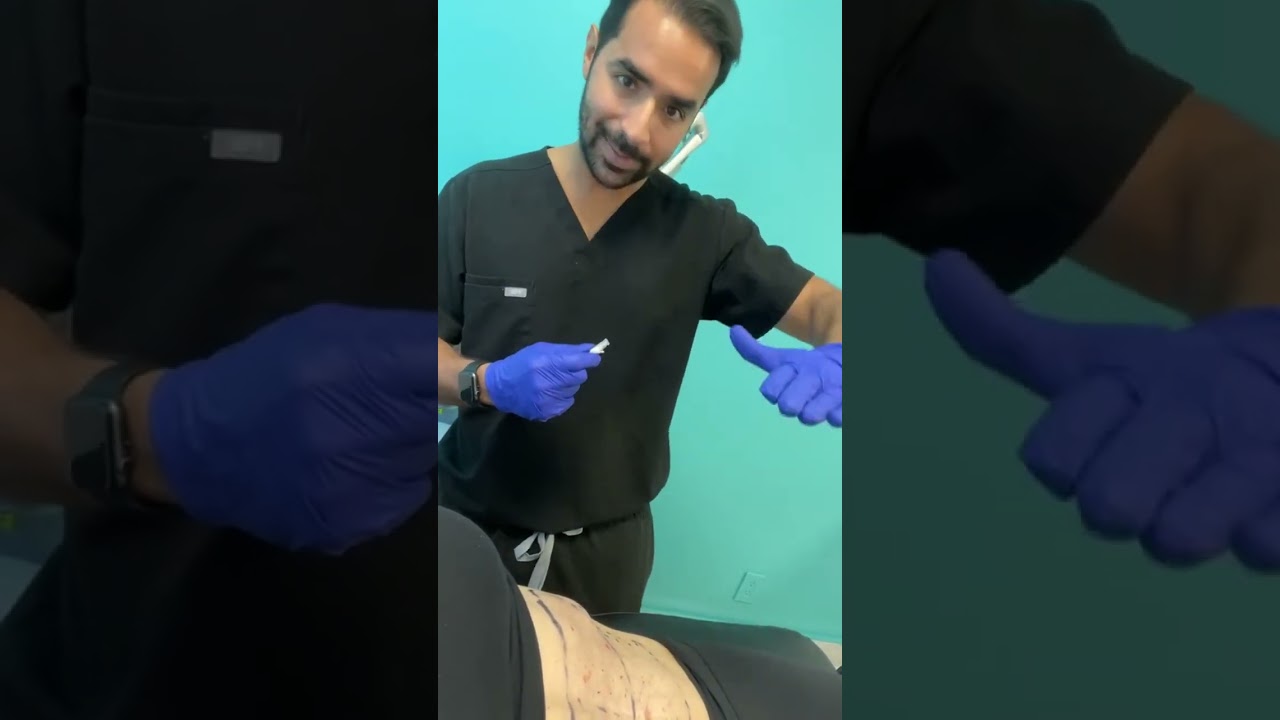 Hyper-diluted @radiesse injections for skin tightening