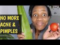 I used FRESH ALOE VERA & tomatoe on my face for 5days/REAL RESULTS