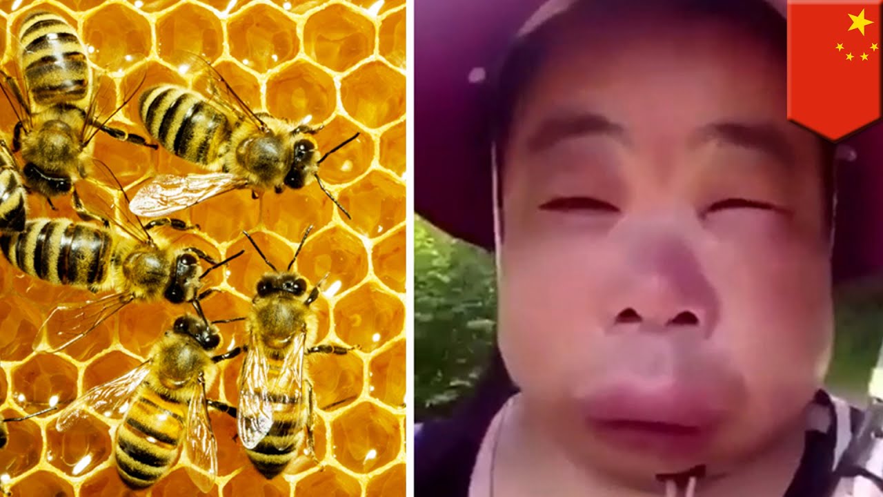 벌집 훔치려다 벌에 쏘여 퉁퉁 부은 여성의 모습이 담긴 영상 화제 - YouTube