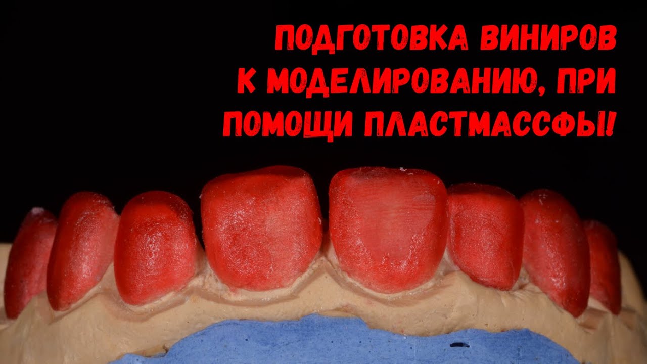 Как изготавливают виниры? Подготавливаем основу для моделирования ...