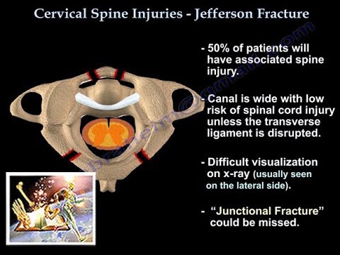 Video: Jefferson Fracture: Symptomer, Behandling, Utvinning Og Mer