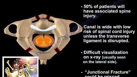 Jefferson Fracture - Everything You Need To Know - Dr. Nabil Ebraheim
