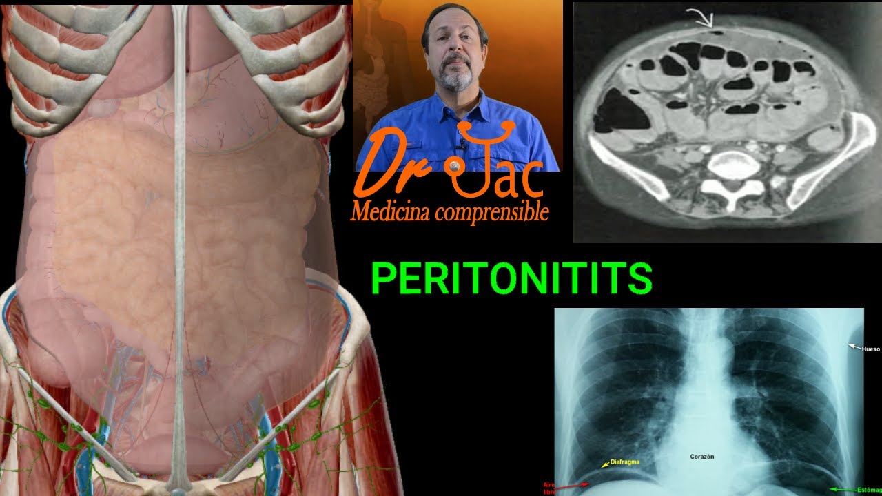 Peritonitis - YouTube