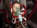Newborn baby nebulization #nicubabycare #foryoupage #Nebulizer