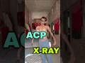 ACP ❌ X-ray ✅ | instagram funny comments part 32 |#funny #commentreading #shorts
