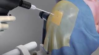 MRI - guided laser ablation