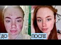 Сотрет / Ретиноиды / Лечение акне до после
