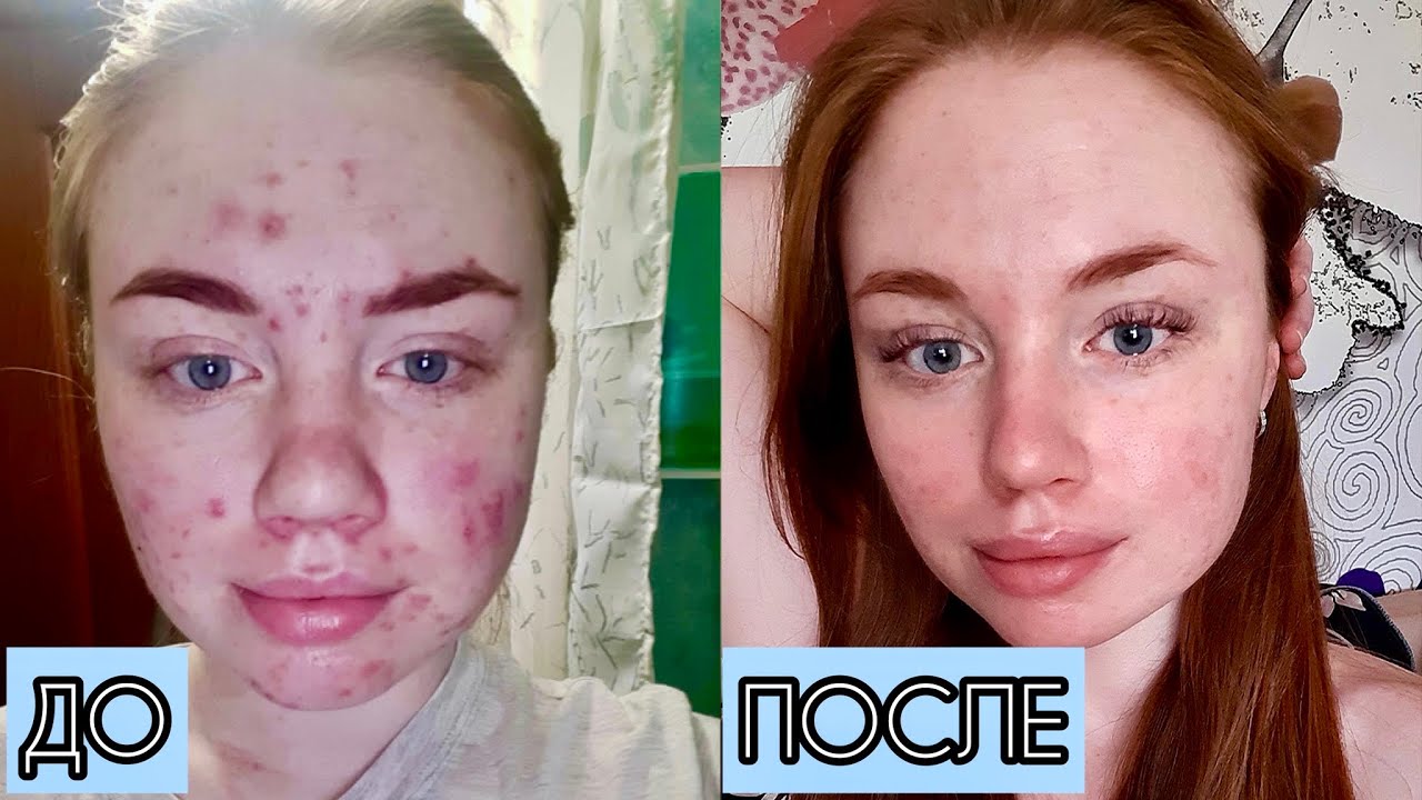 Сотрет / Ретиноиды / Лечение акне до после - YouTube