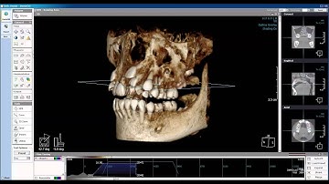 How to Configure Default Window Levels and 3D Opacity in Xelis 3D Imaging