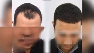 Euro pro hair clinic | شاهد نتائج زراعة الشعر قبل وبعد