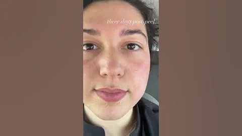 Before and after a peel