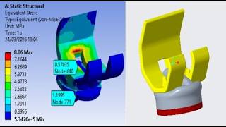 FEA Simulation of total knee replacement implant knee tkr for osteoarthritis and sports gait biomech