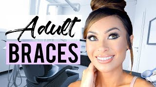 Getting Clear Ceramic Braces (FULL PROCESS!!!) | Week 2