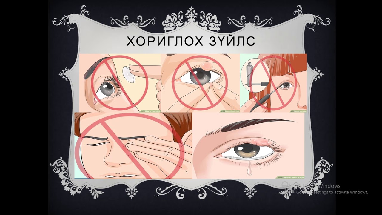 өвдөг ба халазион