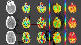 Video 449 1 Endovascular Management of Cerebral Vasospasm